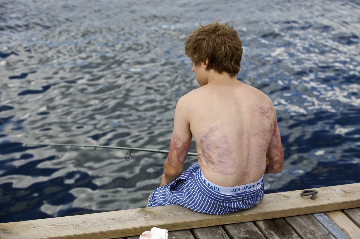 Ung Simen sitter på en brygge og fisker – arrene etter brannskadene synes på ryggen og armene